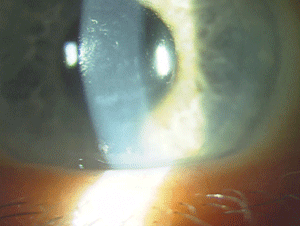 corneal dystrophy endothelial posterior polymorphous dystrophies ic3d classifying jedlicka changes jason courtesy figure reviewofcontactlenses