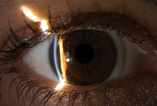 Fig. 1. This patient is wearing a GP lens fit on top of a silicone hydrogel lens due to daily RGP lens awareness. 