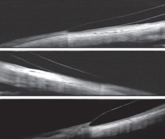 Fig. 3. Here are some OCT image examples. At top, good edge alignment. In the middle, a flat edge lifting off of the conjunctiva. At bottom, a steep edge digging into the conjunctiva. Photos: Jason Jedlika, OD