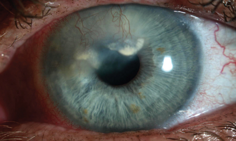 This patient has heavy vascularization and lipid deposition secondary to herpetic keratitis. 