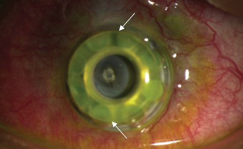 The white arrows in this lower magnification view of the same patient delineate the edge of the front plate. This patient has extrusion with the front plate vaulting from the ocular surface. The donor corneal graft is no longer visible after corneal melt.