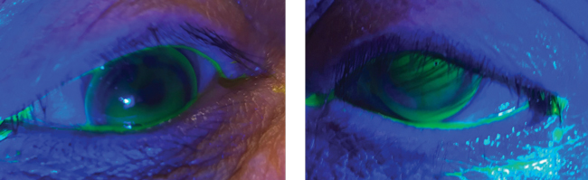 Fig. 2. These images show the RGP lenses on the right and left eyes. You will note the good centration with light apical touch.