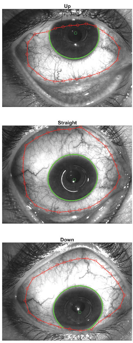 Fig. 1. The sMap3D uses three images in multiple gaze directions to create a single image of the ocular surface. Images: Sheila Morrison, OD. 