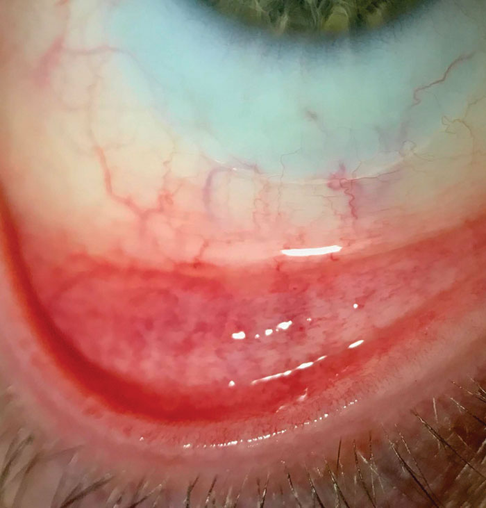 Conditions such as allergic conjunctivitis can hinder success and must be addressed to ensure patient comfort and continued multifocal lens wear.