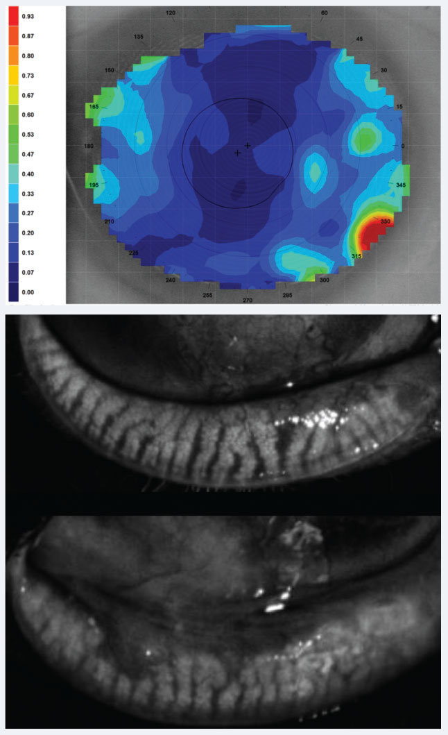 Fig. 4. Above, dynamic tear film stability analysis with cooler colors representing uniform, denser tear layer and hot colors representing thinning and poor consistency, may shed light on CLD related to poor tear film quality. Below, meibography showing healthy glands above and glands with truncation and close to 50% loss inferiorly. 