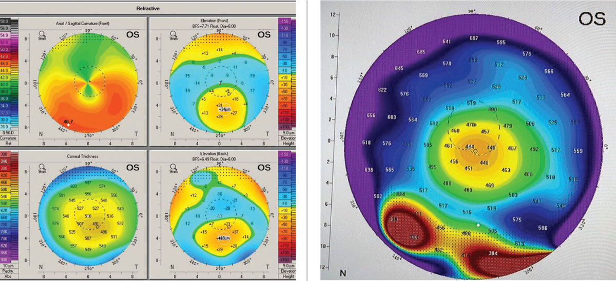 Figs 2 and 3. (Left) The upper right axial or curvature map of the anterior cornea shows the “crab claw” or “kissing dove” pattern. (Right) Global pachymetry display from Pentacam with area in true PMD shows the band of inferior peripheral corneal thinning. Images: Tom Arnold, OD. 