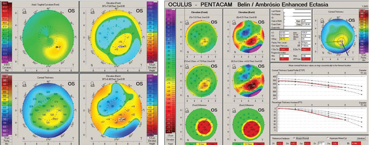 Fig 6. (Left) Pentacam OS 4-Map Refractive Display shows classic keratoconic patterns. (Right) Ectasia Display OS shows strongly positive ectasia detection.