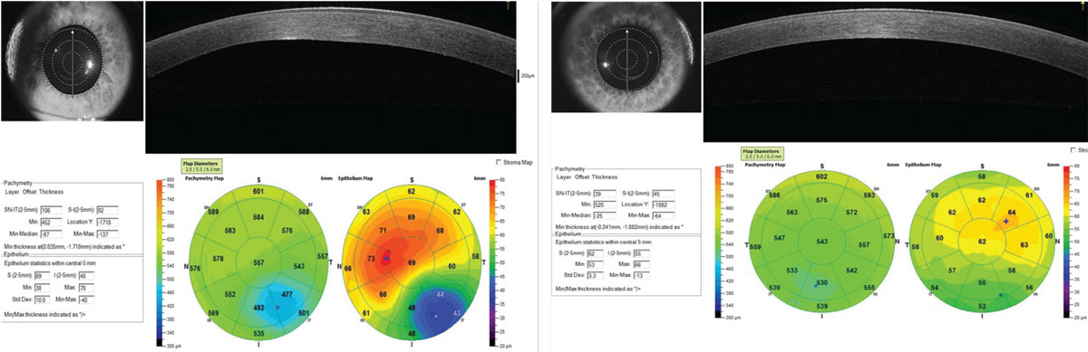 Fig 7. Pachymetry Display. (Left) OS shows abnormal global corneal thickness and a classic pattern of thinning of the epithelium over the cone apex and surrounding epithelial thickening. (Right) OD shows normal global corneal thickness but abnormal epithelial thickness distribution.