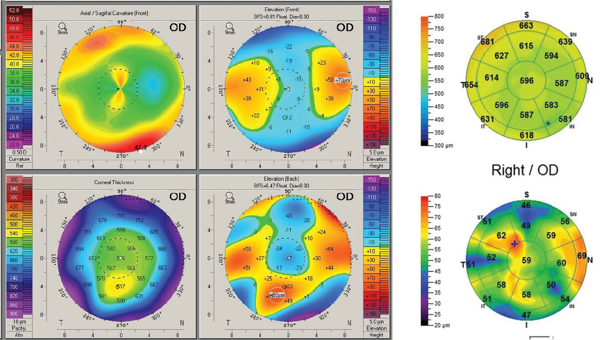 Fig. 8. Post-RK/LASIK. (Left) Pentacam 4-Map Refractive Display shows non-orthogonal irregular astigmatism within the pupillary zone and significant anterior elevation asymmetry. (Right) OCT pachymetry map shows significant irregularity of the epithelial thickness but no evidence of ectasia.