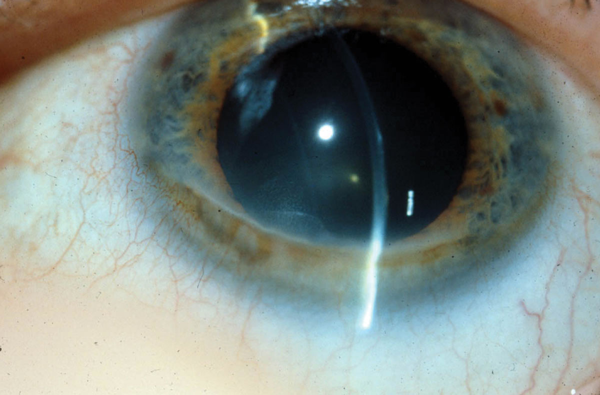 In Terrien’s marginal degeneration, a clear zone of thinning with thin blood vessels crossing through is present. Opacification is associated with the steep, more central edge.