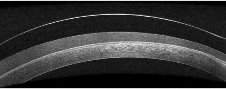 Fig. 1. OCT imaging shows fogging under a scleral lens.