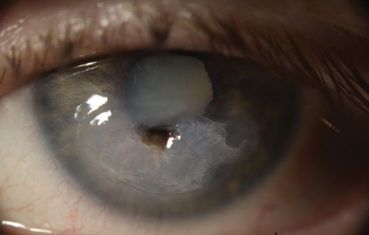Fig. 3. The patient underwent emergency penetrating keratoplasty (PK) followed by a repeat PK with cataract extraction. The culture performed prior to the first corneal transplant was negative for microbial growth. Due to a persistent epithelial defect following PK, she needed multiple Prokera (Bio-Tissue) membranes, tarsorrhaphy and an amniotic membrane transplant. Post-op visual acuity was 20/400 with pinhole acuity ranging from 20/80 to 20/200.