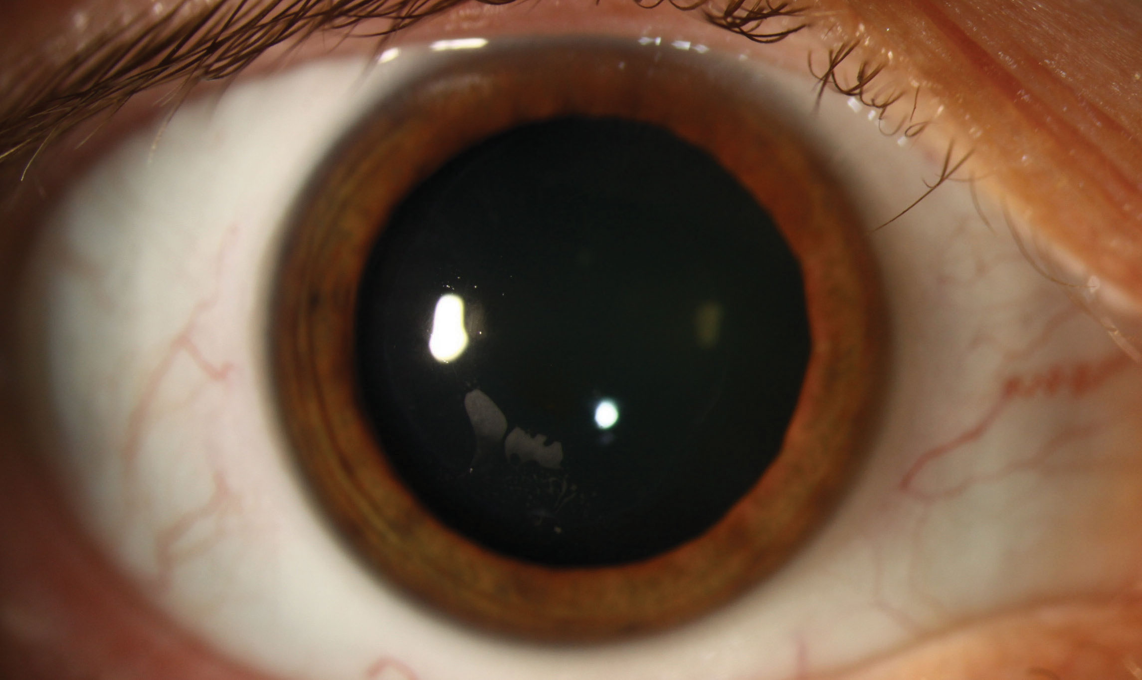 This patient has post-LASIK epithelial ingrowth, a rare complication characterized by the ingrowth of corneal epithelium at the interface between the flap and stromal bed.