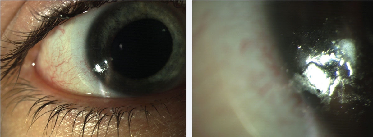 Fig. 1. Patients can present with both protein and lipid deposits. These common lens deposits are shown here at (left) low and (right) high magnification.