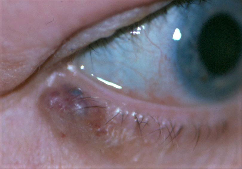 A pigmented basal cell carcinoma margin lesion is noticeable on this eyelid.