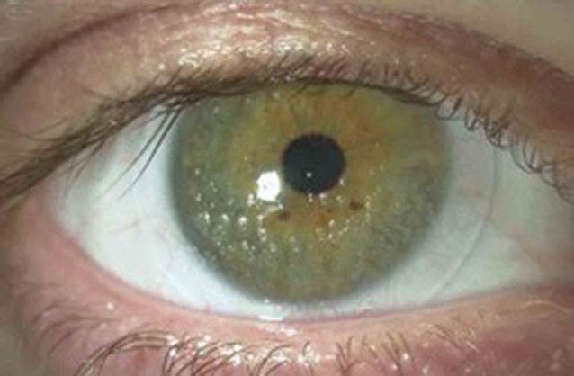 Fig. 2. This patient presented with distinct, localized elevations on the anterior surface of the lens—lens calculi.
