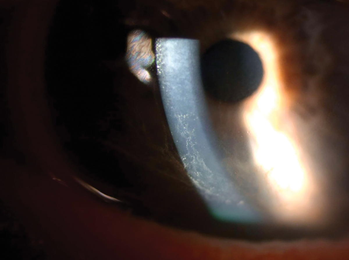 Corneal epithelial deposits on the inferior half of the cornea.