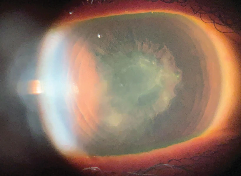 A corneal scar from HSV with a persistent epithelial defect after a corneal erosion.