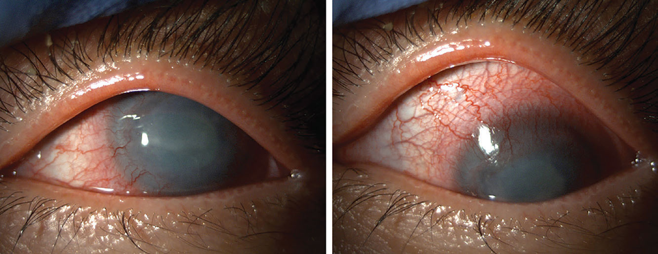 AK and conjunctival injection.