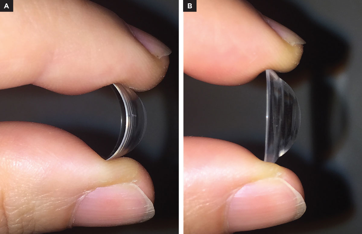 Fig. 1. (A) High Dk scleral lens flexing. (B) A scleral lens of the same diameter and thickness but with higher modulus.