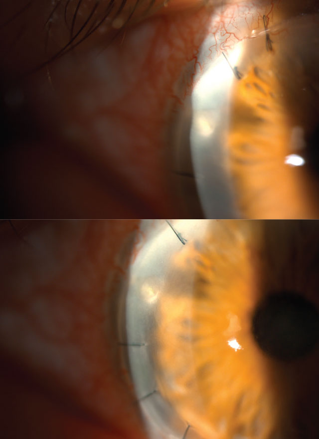 Infectious keratitis, resultant of an ulcerative epithelial defect.