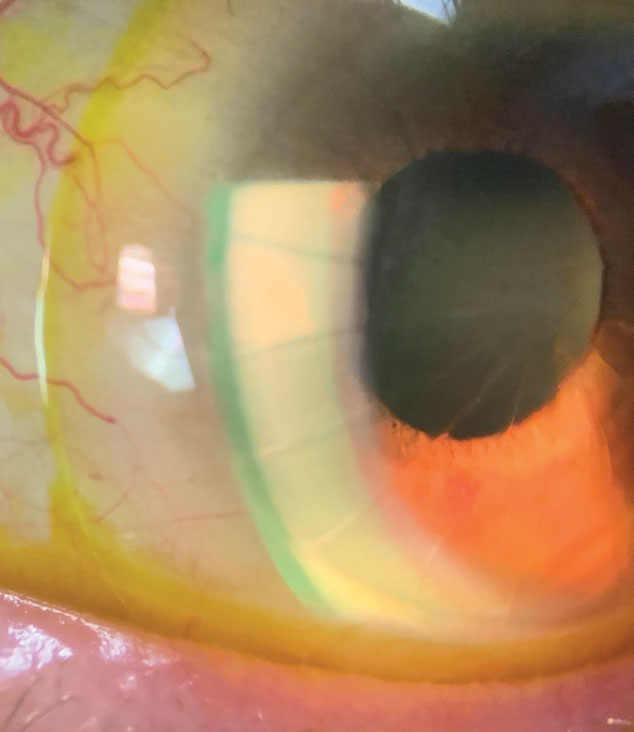 A scleral with sodium fluorescein on an eye with radial keratectomy, lipid keratitis and neovascularization. 