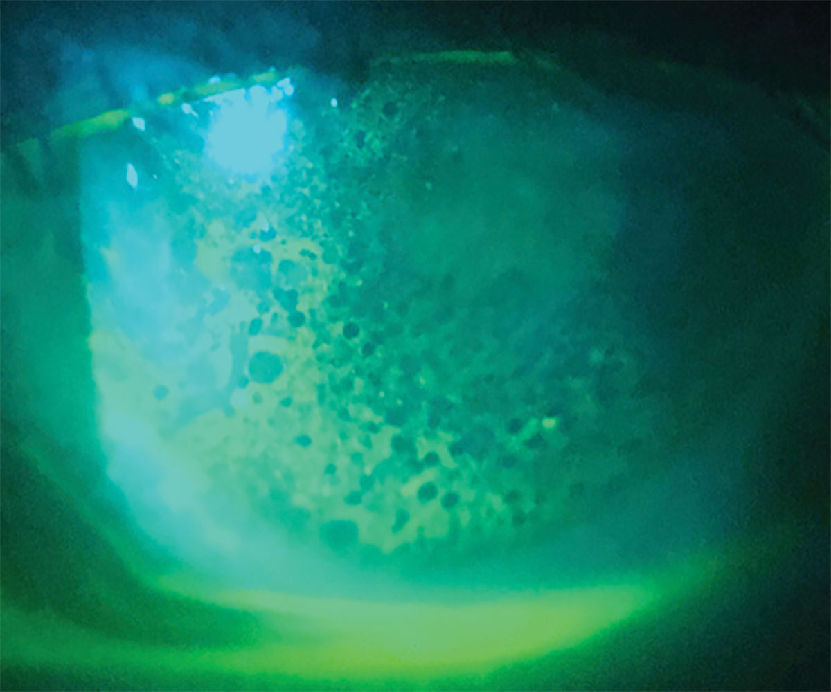 Fig. 1. Corneal edema presenting with microcystic edema and negative fluorescein staining.