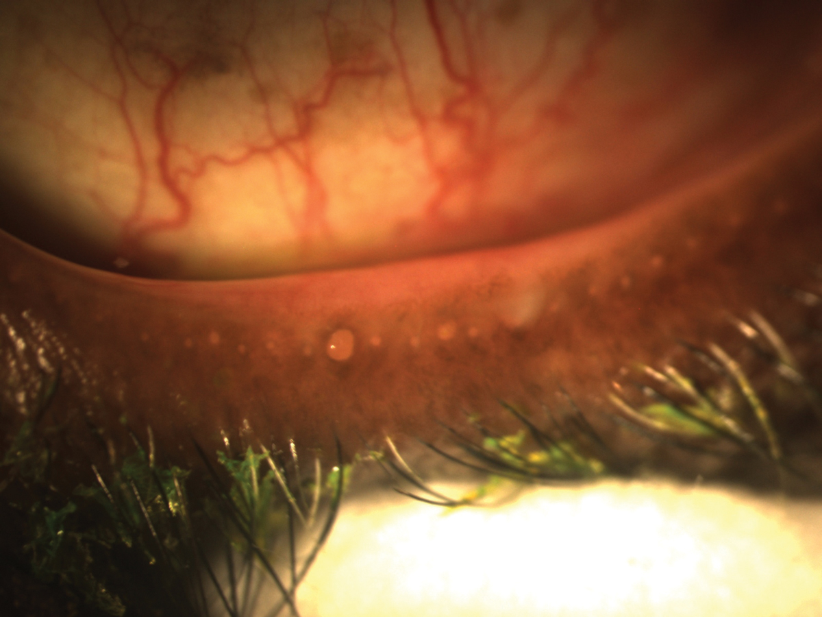 Manage existing meibomian gland disease or signs of dry eye throughout the fitting process to ensure that any associated symptoms do not interfere with comfort or visual outcomes of the lenses.