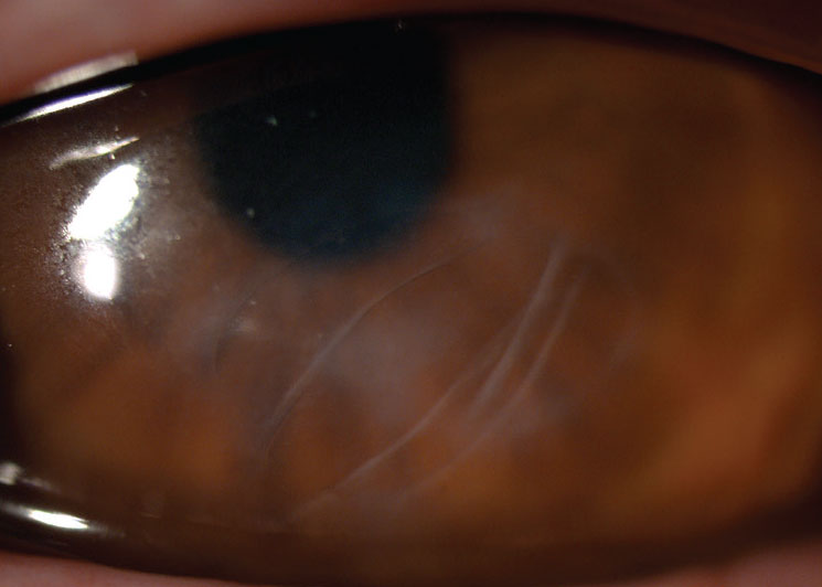 Residual scarring after corneal hydrops.