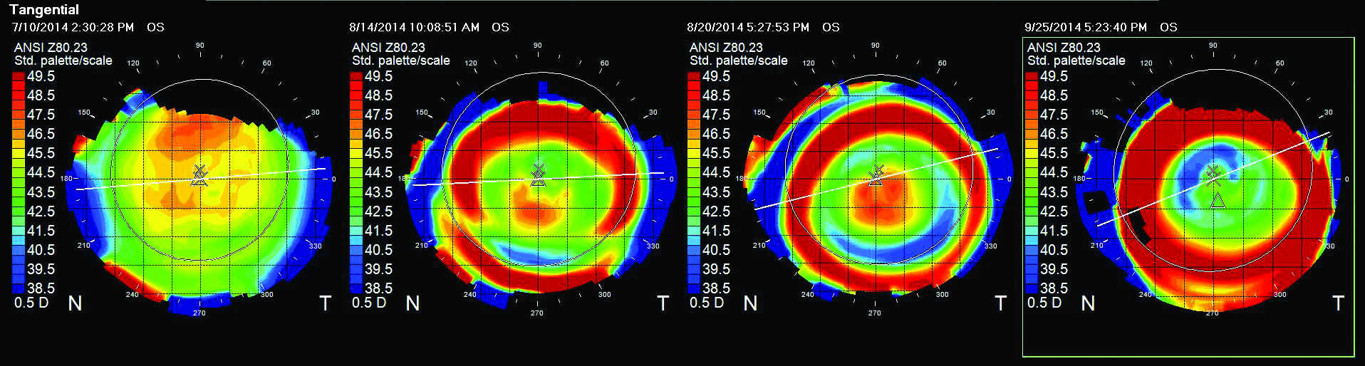 Resolving Central Islands Caused By Overnight Corneal Reshaping