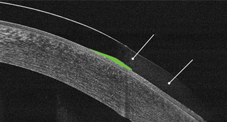 Fig. 2. This OCT image highlights the company’s so-called “HyperBond” junction, designed to help reduce lens tearing. Photo: SynergEyes