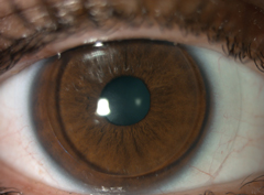 Fig. 3. This patient was fit with a Duette hybrid lens with a silicone hydrogel skirt.