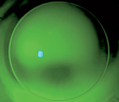 Fig. 6. The right SynergEyes KC lens on this patient demonstrates “feather” touch with intermediate tear pooling. Photo: Robert L. Gordon, OD, and Sharon S. Hiyama, OD