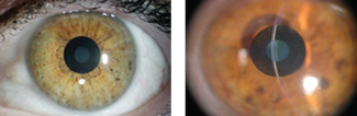 Kamra inlays, shown here, are implanted into a corneal pocket made with a femtosecond laser. Photos: Vance Thompson, MD 