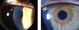 Through a hyperprolate corneal shape and epithelial remodeling, Raindrop Near Vision Inlays, shown here, create a multifocal cornea. Photos: Vance Thompson, MD