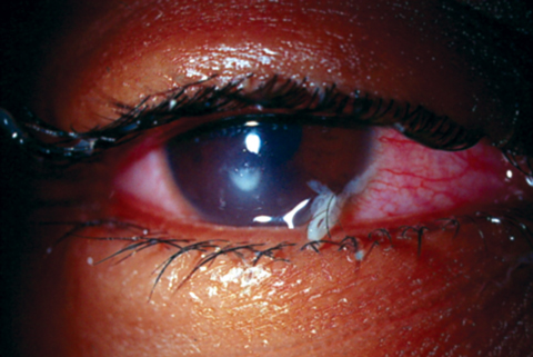 This extended wear patient developed culture-proven Pseudomonas keratitis that has mucopurulent discharge. Photo: Joseph Sowka, OD, and Alan G. Kabat, OD
