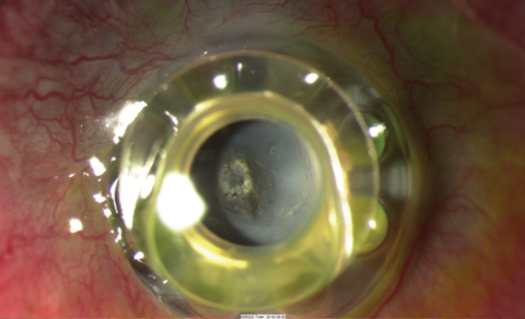 A dense retroprosthetic membrane in a Boston KPro type 1, as seen here, required surgical removal, but Nd:YAG laser was attempted in the early stage of membrane formation. This patient also has extrusion with the front plate vaulting from the ocular surface.