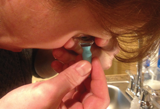 Fig. 1. A large plunger is a helpful tool to insert scleral lenses.
