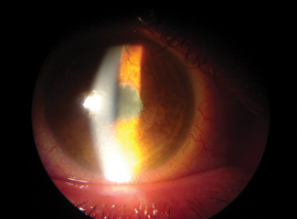Patients with anterior uveitis are often treated with a potent topical steroid, which can cause an increase in intraocular pressure. New treatments under investigation may avoid this potential adverse effect. Photo: Paul C. Ajamian, OD