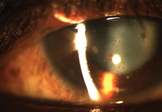 Electronic stimulation of ocular tissues to improve drug penetration—called iontophoresis—may soon be available for anterior uveitis.