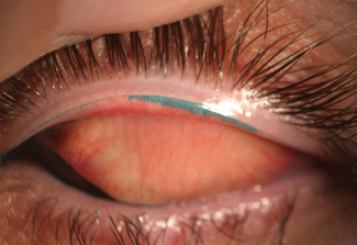 Fig. 5. Lid wiper staining with lissamine green indicates ocular surface damage.