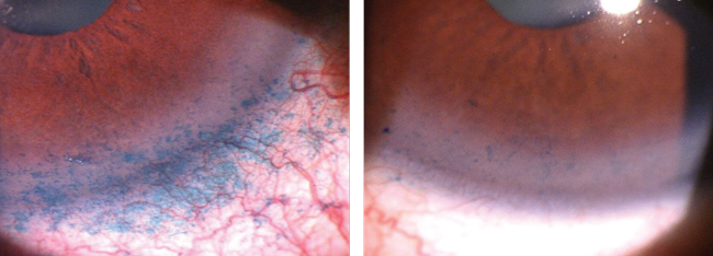 Lissamine green staining of the conjunctiva and cornea identifies BAK toxicity from chronic prostaglandin use. This patient was switched to a preservative-free prostaglandin analog. His signs and symptoms of dry eye improved over the next three months. Photo: James Aquavella, MD