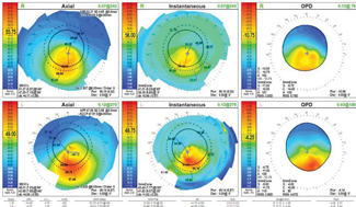 Fig. 1. The patient’s corneal topography shows that the inferior central cones are steeper OD than OS. 