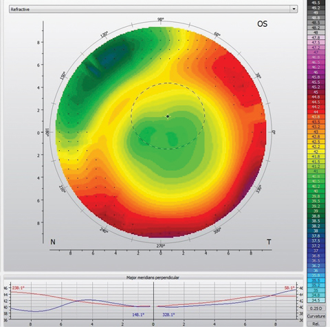 Fig. 3. The topography of this center-distance scleral lens demonstrates inferior-temporal decentration. Note the high degree of varying power in front of the pupil (dotted black circle). 