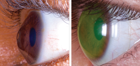 These images show a keratoconus patient before, at left, and after being fit with a medically necessary scleral lens. Photos: Tom Arnold, OD