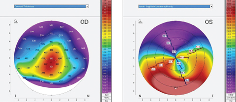 Topography can be instrumental when fitting medically necessary contact lenses for patients with conditions such as pellucid marginal degeneration. Photos: Tom Arnold, OD
