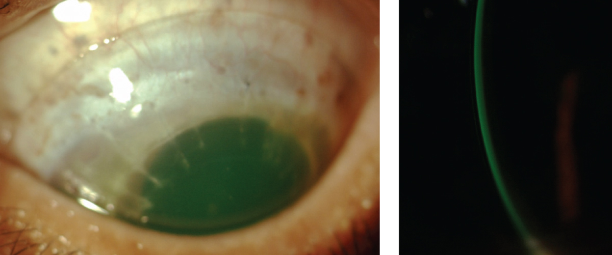 Example of an acceptable scleral lens fit on a post-PKP patient. Central clearance is 200μm and there is no haptic blanching or compression.