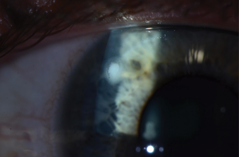 Despite the reduced lens care needs of daily disposables, wearers are still at risk for microbial keratitis, as seen here. Photo: Jeffrey Sonsino, OD, and Shachar Tauber, MD