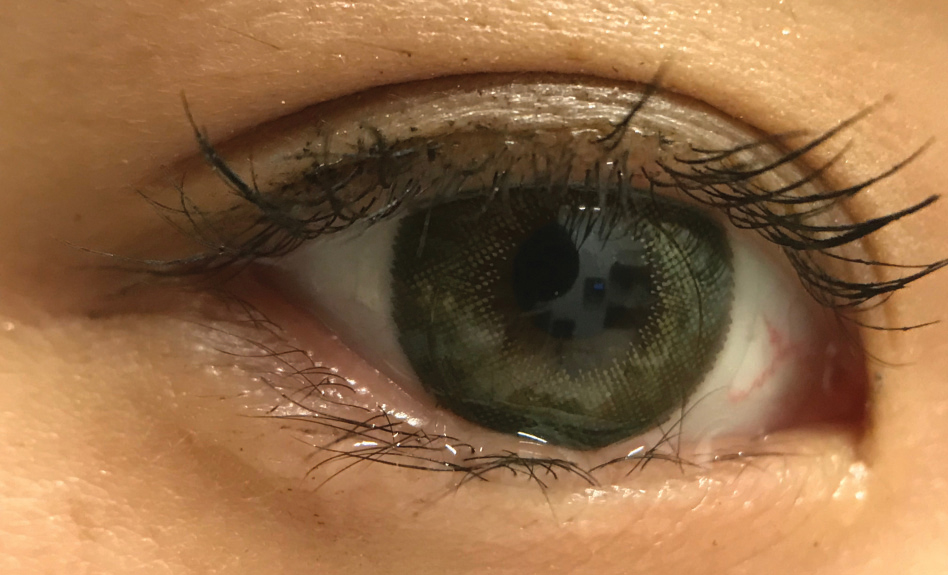 Soft colored contact lenses, shown above, can serve to make other modalities more appealing through piggybacking options.
