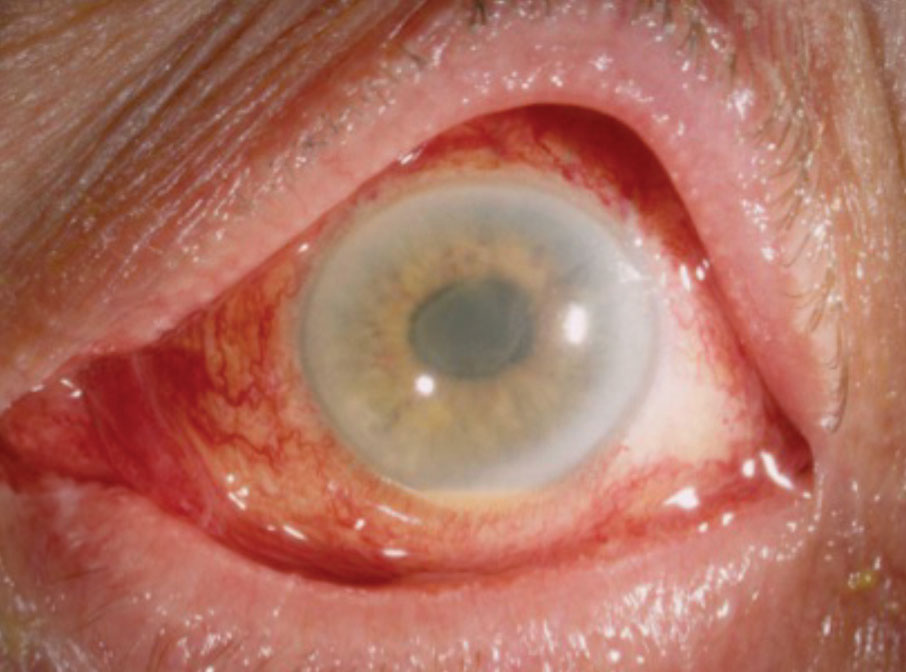 inflammation 6 weeks after cataract surgery)